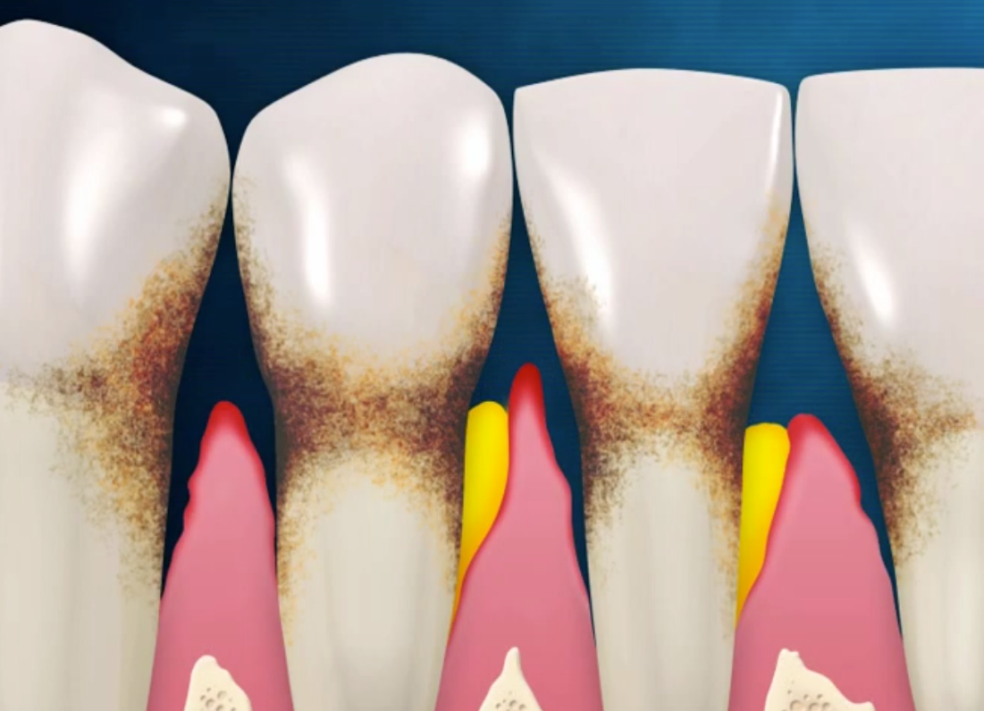 Wortwolke in Form einer Zahnpastatube mit Begriffen wie Kaliumnitrat, Anti-Gingivitis und Karies-Schutz.